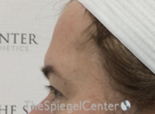 Forehead Contouring Before & After Gallery - Patient 267533 - Image 3