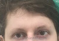 Forehead Contouring Before & After Gallery - Patient 372748 - Image 1