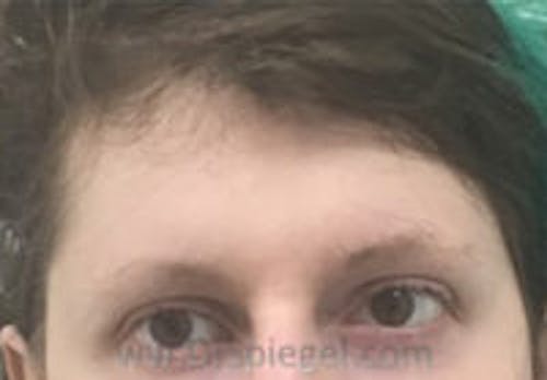 Forehead Contouring Before & After Gallery - Patient 372748 - Image 1