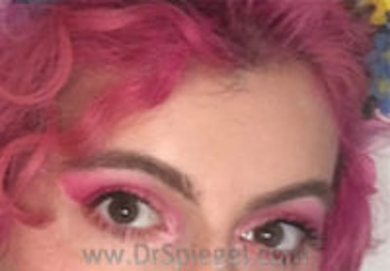 Forehead Contouring Before & After Gallery - Patient 372748 - Image 2