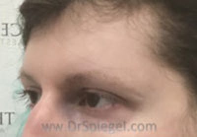 Forehead Contouring Before & After Gallery - Patient 372748 - Image 3