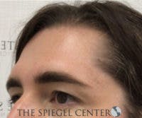 FFS Forehead Contouring Before & After Gallery - Patient 392734 - Image 1