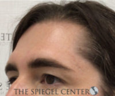 Forehead Contouring Before & After Gallery - Patient 348043 - Image 1