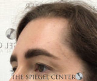 Forehead Contouring Before & After Gallery - Patient 348043 - Image 2