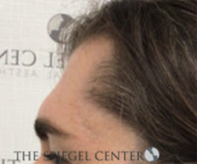 FFS Forehead Contouring Before & After Gallery - Patient 392734 - Image 3