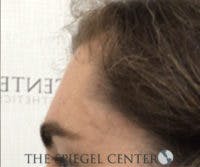 FFS Forehead Contouring Before & After Gallery - Patient 392734 - Image 4