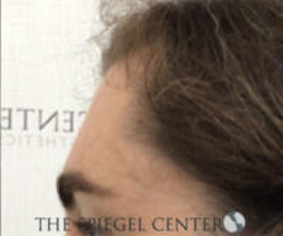 Forehead Contouring Before & After Gallery - Patient 348043 - Image 4