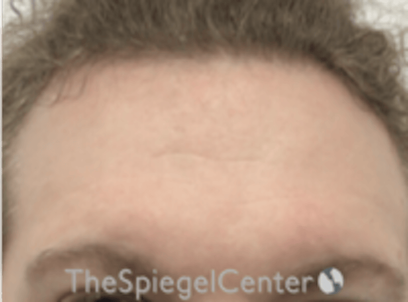 Forehead Contouring Before & After Gallery - Patient 116614 - Image 1