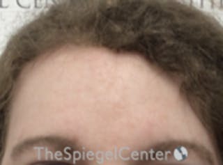 Forehead Contouring Before & After Gallery - Patient 116614 - Image 2
