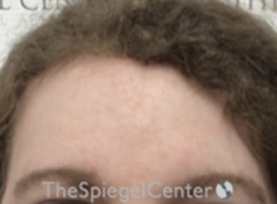Forehead Contouring Before & After Gallery - Patient 116614 - Image 2