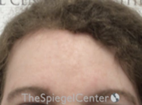 Forehead Contouring Before & After Gallery - Patient 116614 - Image 2