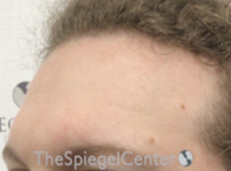 Forehead Contouring Before & After Gallery - Patient 116614 - Image 3