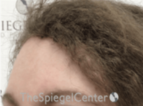 Forehead Contouring Before & After Gallery - Patient 116614 - Image 4