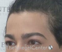 FFS Forehead Contouring Before & After Gallery - Patient 654081 - Image 1