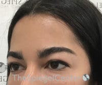 FFS Forehead Contouring Before & After Gallery - Patient 654081 - Image 2