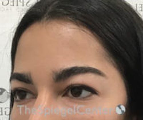 Forehead Contouring Before & After Gallery - Patient 380581 - Image 2
