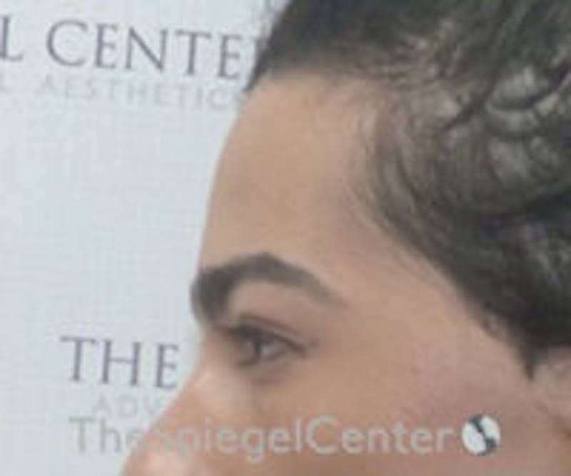 FFS Forehead Contouring Before & After Gallery - Patient 654081 - Image 3