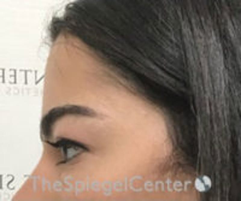 FFS Forehead Contouring Before & After Gallery - Patient 654081 - Image 4