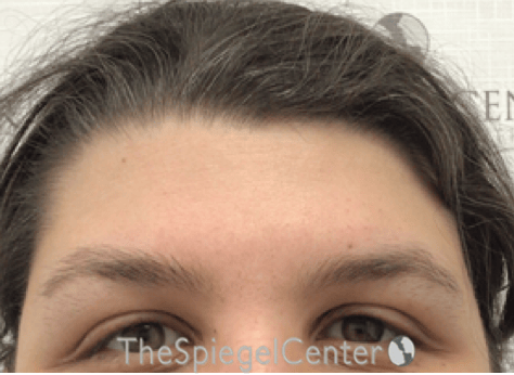 FFS Forehead Contouring Before & After Gallery - Patient 317902 - Image 1