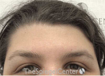 Forehead Contouring Before & After Gallery - Patient 564519 - Image 1