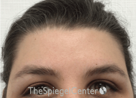 FFS Forehead Contouring Before & After Gallery - Patient 317902 - Image 2