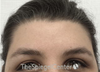 Forehead Contouring Before & After Gallery - Patient 564519 - Image 2