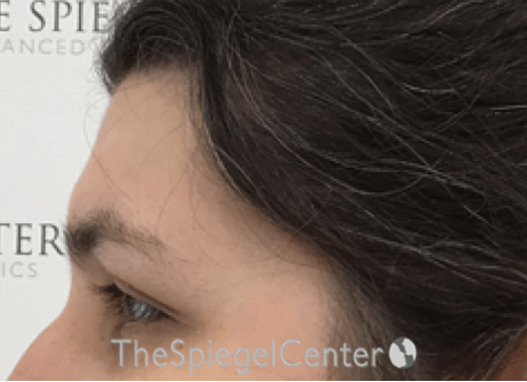FFS Forehead Contouring Before & After Gallery - Patient 317902 - Image 3