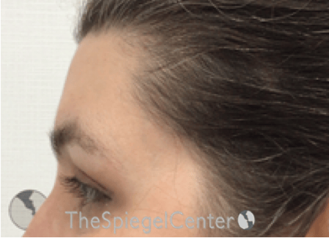 FFS Forehead Contouring Before & After Gallery - Patient 317902 - Image 4