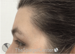 Forehead Contouring Before & After Gallery - Patient 564519 - Image 4
