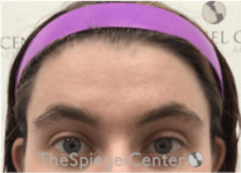 Forehead Contouring Before & After Gallery - Patient 186561 - Image 1