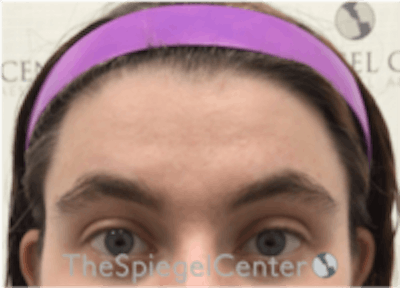 Forehead Contouring Before & After Gallery - Patient 186561 - Image 1