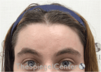 FFS Forehead Contouring Before & After Gallery - Patient 463280 - Image 2