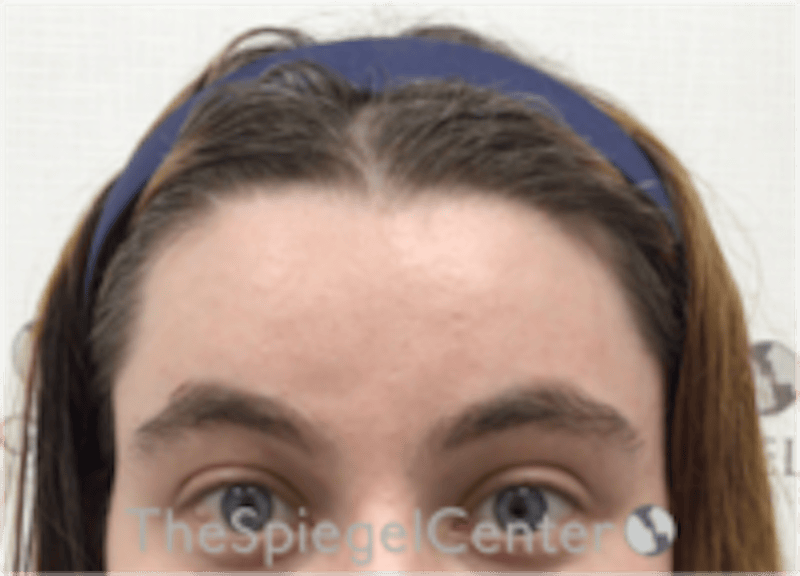 Forehead Contouring Before & After Gallery - Patient 186561 - Image 2
