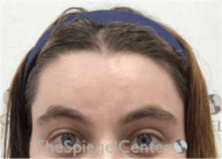 Forehead Contouring Before & After Gallery - Patient 186561 - Image 2