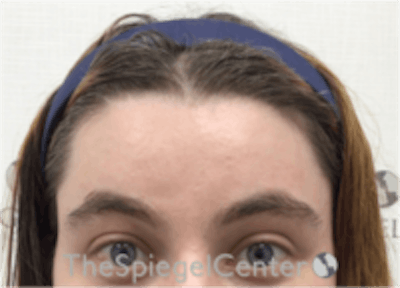 Forehead Contouring Before & After Gallery - Patient 186561 - Image 2