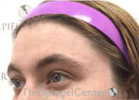 FFS Forehead Contouring Before & After Gallery - Patient 463280 - Image 3