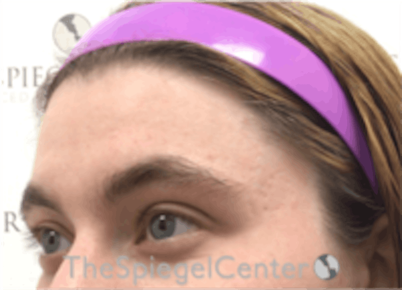 Forehead Contouring Before & After Gallery - Patient 186561 - Image 3