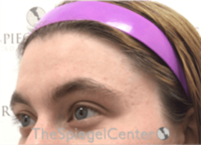 Forehead Contouring Before & After Gallery - Patient 186561 - Image 3