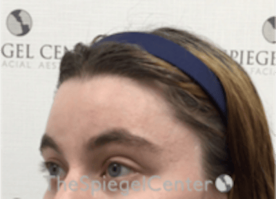 Forehead Contouring Before & After Gallery - Patient 186561 - Image 4