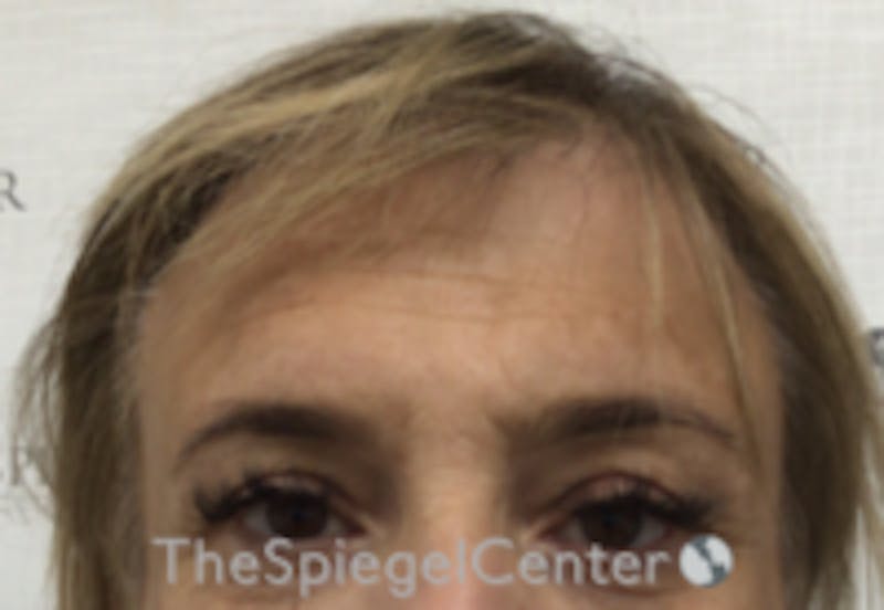 Forehead Contouring Before & After Gallery - Patient 243586 - Image 1