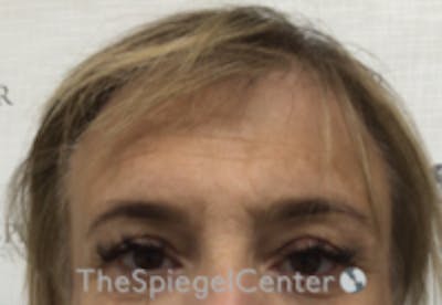 Forehead Contouring Before & After Gallery - Patient 243586 - Image 1
