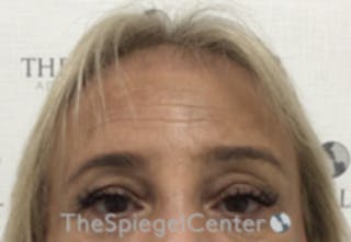 Forehead Contouring Before & After Gallery - Patient 243586 - Image 2