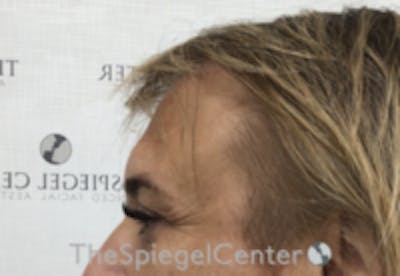 Forehead Contouring Before & After Gallery - Patient 243586 - Image 3