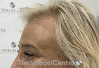 Forehead Contouring Before & After Gallery - Patient 243586 - Image 4