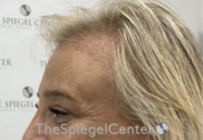 Forehead Contouring Before & After Gallery - Patient 243586 - Image 4