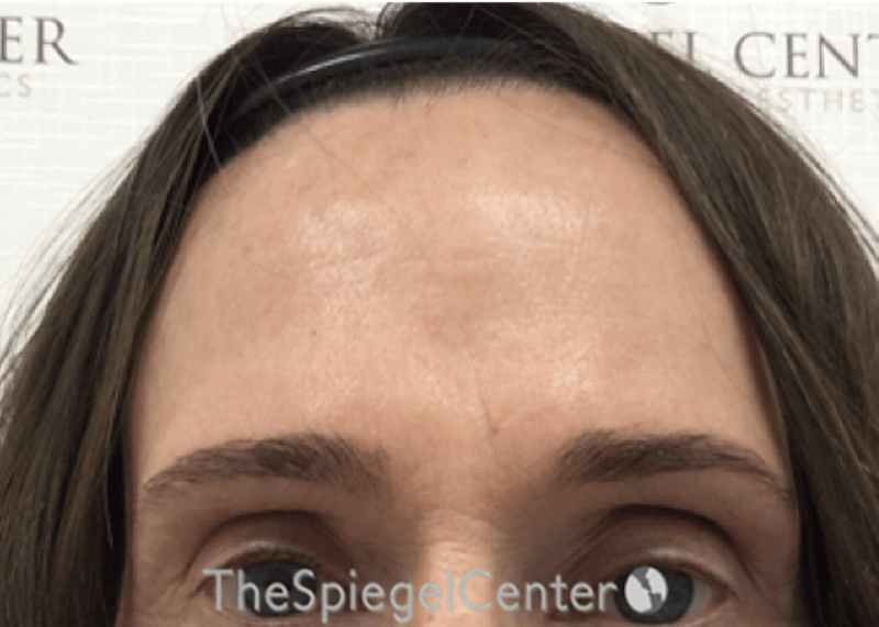 Forehead Contouring Before & After Gallery - Patient 318309 - Image 1