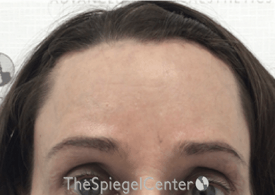 Forehead Contouring Before & After Gallery - Patient 318309 - Image 2