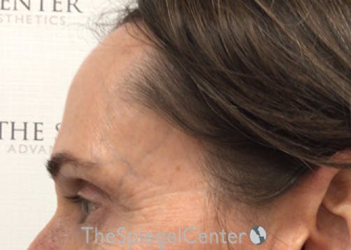FFS Forehead Contouring Before & After Gallery - Patient 349462 - Image 3