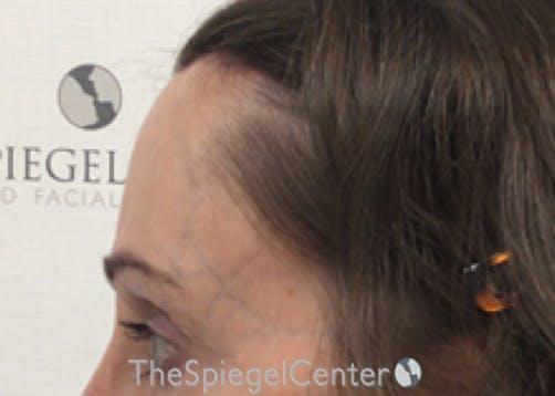 FFS Forehead Contouring Before & After Gallery - Patient 349462 - Image 4