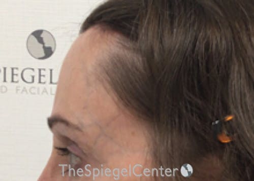 Forehead Contouring Before & After Gallery - Patient 318309 - Image 4